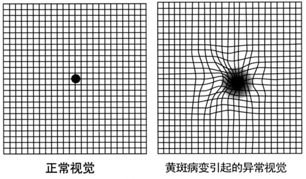 看東西發(fā)生扭曲，是什么眼?。? /></a></div>            
                             
                <div   id=